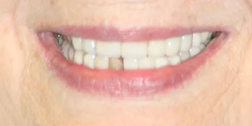 before lower anterior veneers