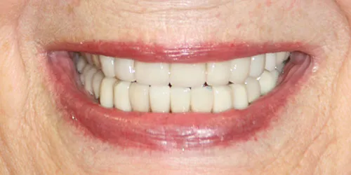 after lower anterior veneers