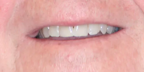 after teeth whitening