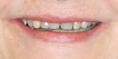 before Upper Anterior Crowns