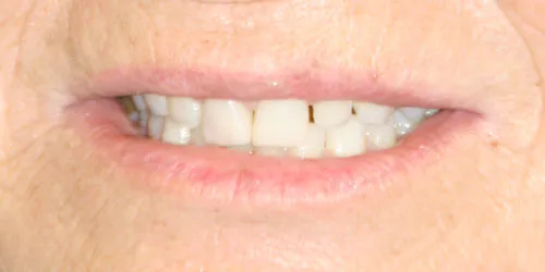 before Upper Anterior Crowns