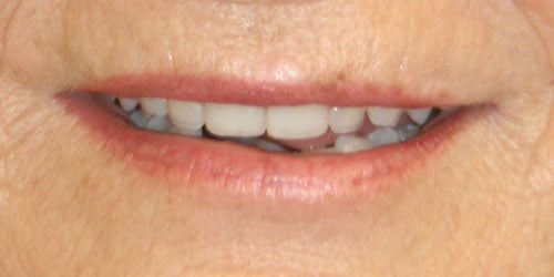 after Upper Anterior Crowns