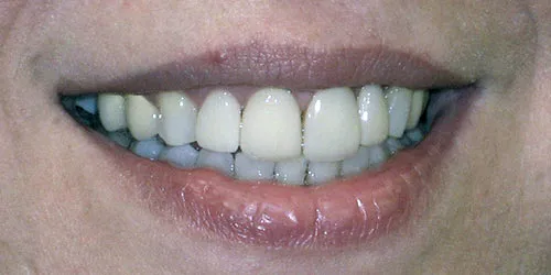 after upper anterior veneers