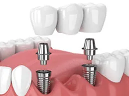 implant supported bridge illustration