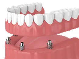implant supported denture illustration