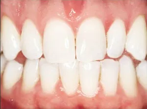 after teeth whitening