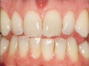 before teeth whitening