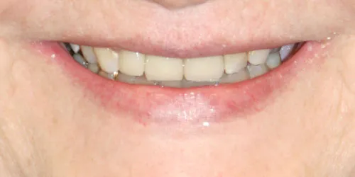 After Anterior Upper Crowns