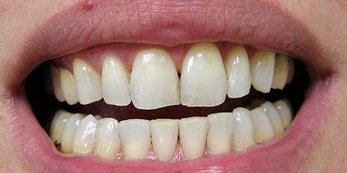 Before upper anterior veneers